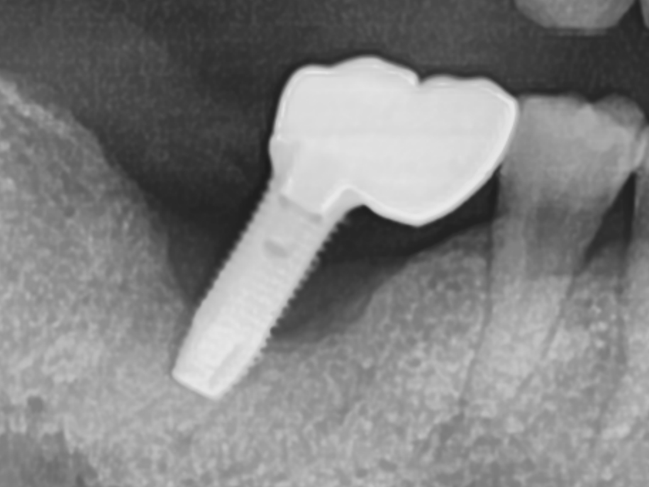 임플란트 재치료