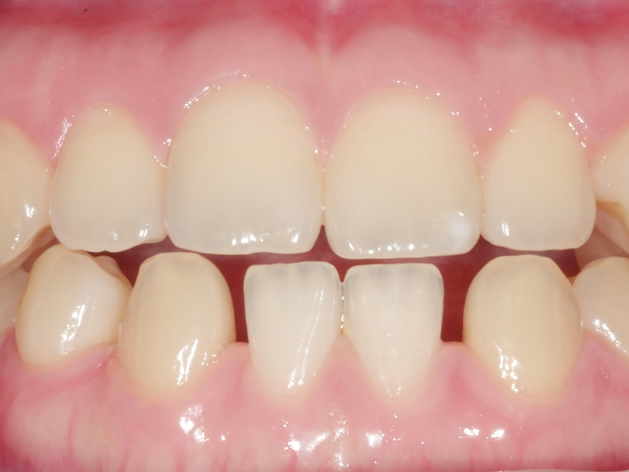 아래 앞니 치아 벌어짐 치료